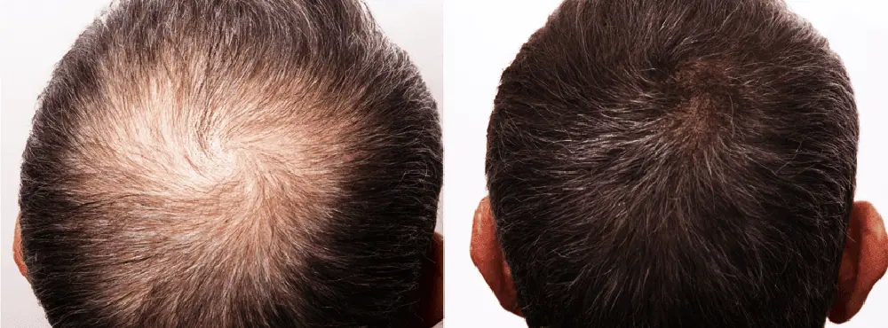 Hair Restoration for men in Pueblo, CO