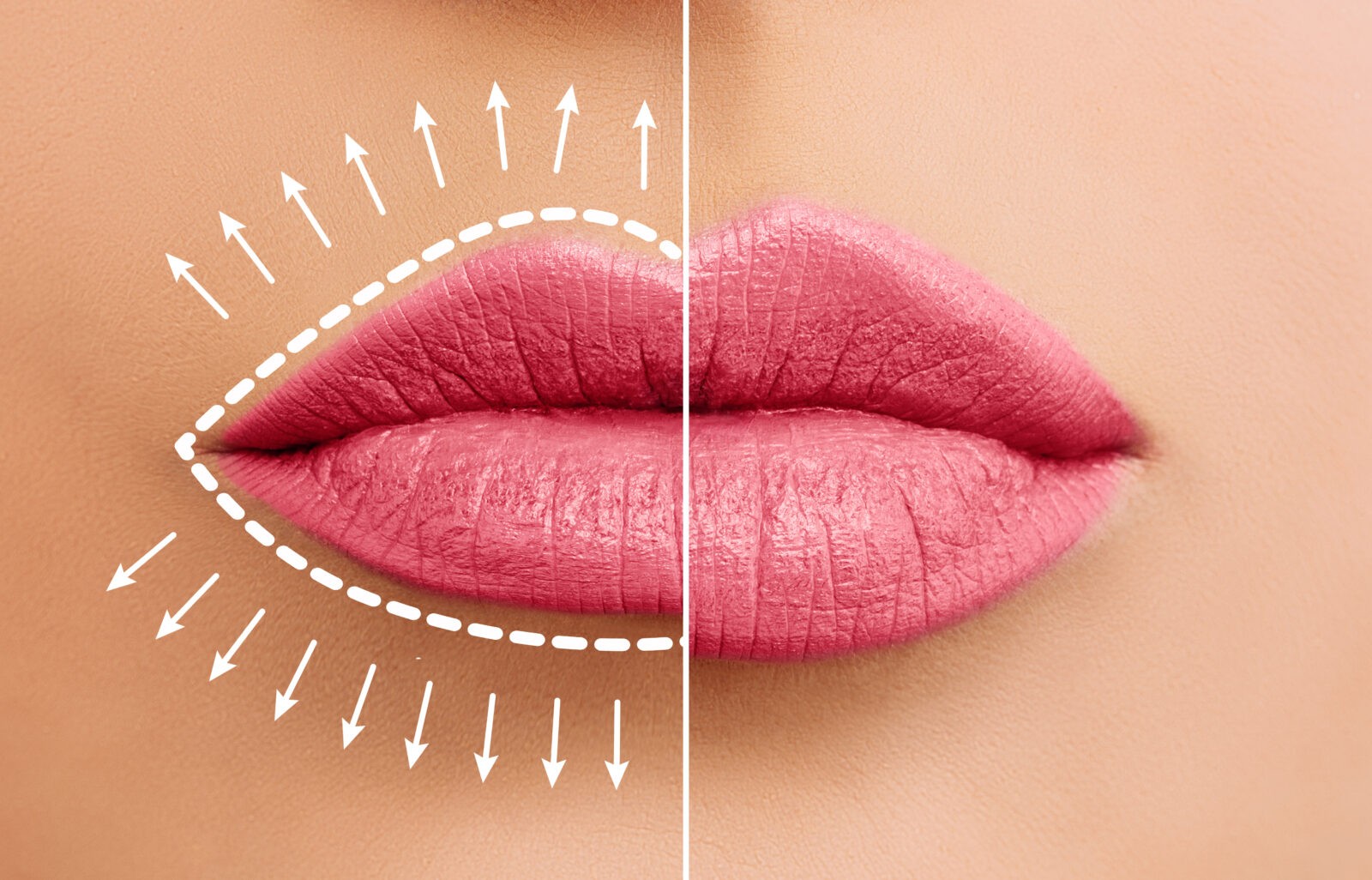 best injections for lips