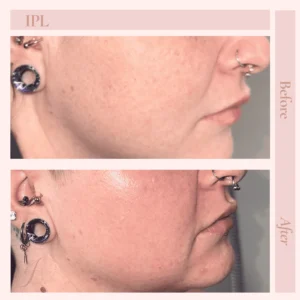 O Before and After Treatment Images in Pueblo, CO
