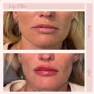 P Before and After Treatment Images in Pueblo, CO